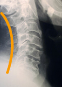 なぜ交通事故のケガ・むち打ちが ここまで圧倒的に改善するのか?