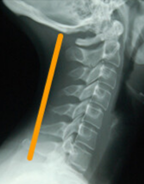 なぜ交通事故のケガ・むち打ちが ここまで圧倒的に改善するのか?